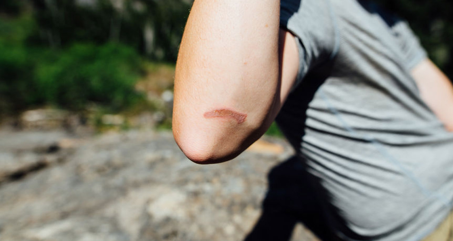 Why Scars Happen, Plus the 7 Best Scar Treatments