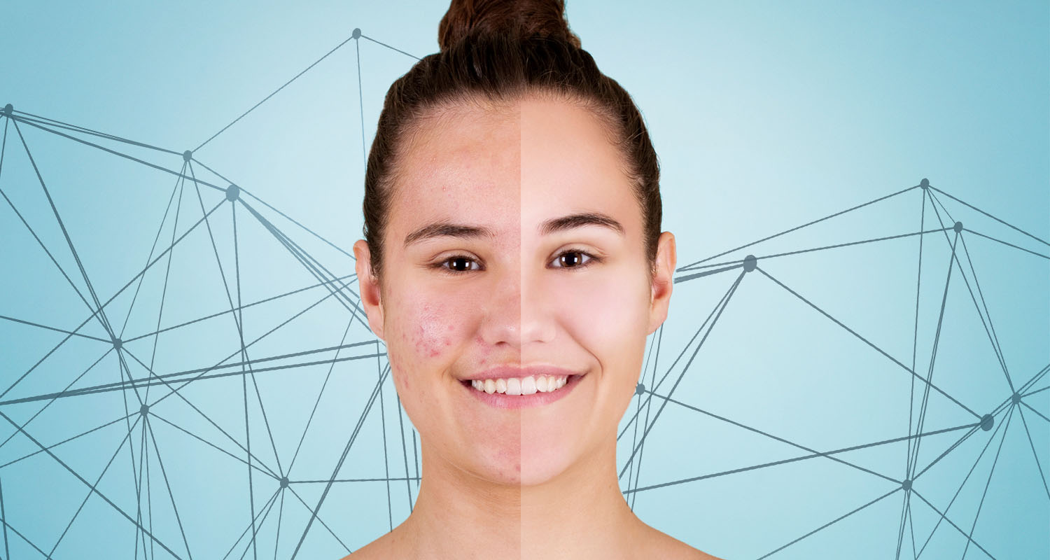All About Acne, and Why Your Dermatologist Isn’t Doing You Any Favors
