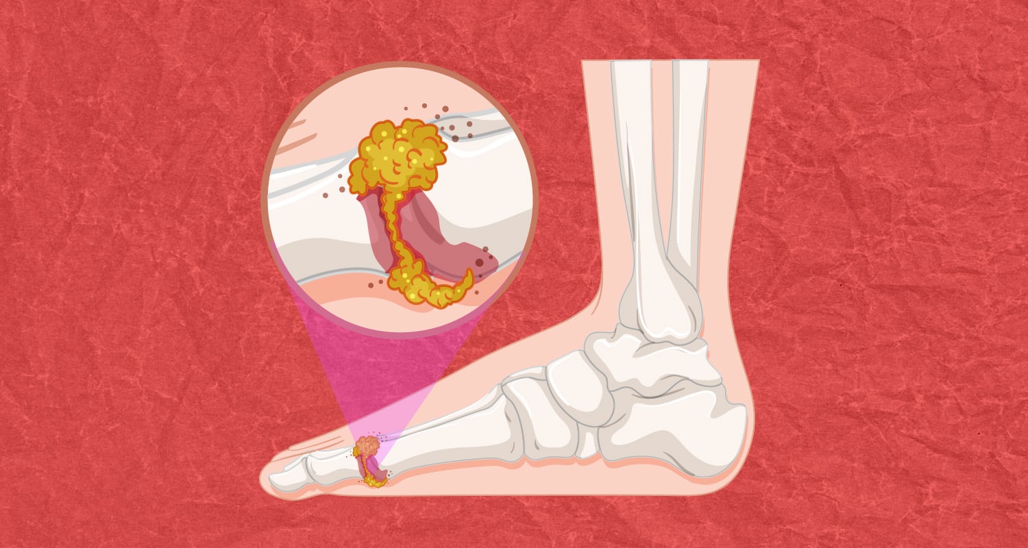 Why Gout is On The Rise and How Your Diet Plays a Part in Symptoms_header