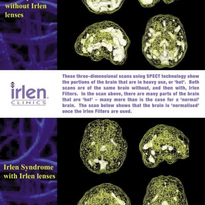 irlen syndrome
